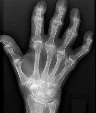 leggi tutto l'articolo: Il Dolore alla Mano: non sempre è l'Artrosi, una diagnosi non sempre agevole Il Dolore alla Mano: non sempre è l'Artrosi, una diagnosi non sempre agevole