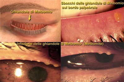 leggi tutto l'articolo: Blefarite cronica Blefarite cronica