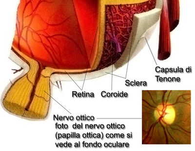 Escavazione testa nervo ottico