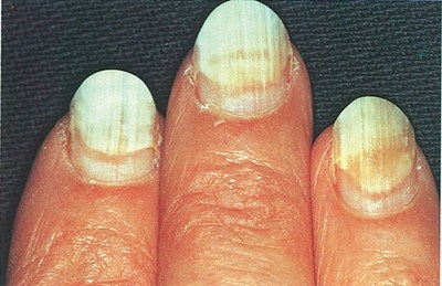 Not All Ugly Toenails are Fungus - Debra E. Young, DPM