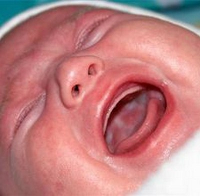 allergie-neonati-cesareo