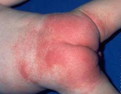 arrossamento-eritema-dermatite
