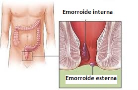 Immagini che mostra la formazione di emorroidi interne ed esterne