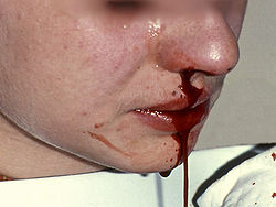 adolescente durante la fuoriuscita di sangue dal naso