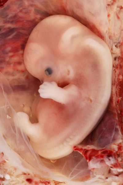 la gravidanza extrauterina o ectopica in cui l'impianto avviene al di fuori della sede prestabilita