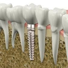immagine relativa ad un illustrazione di implantologia dentale