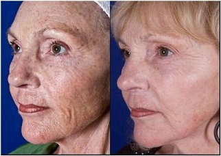 laser-dermatologico-CO trattamento prima e dopo