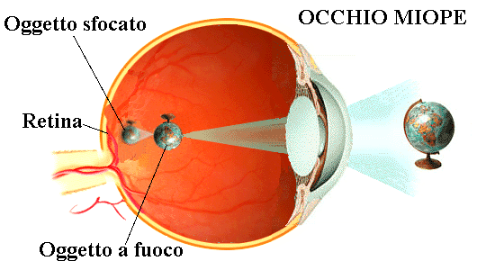 occhio-miopia-retina-fuoco-sfocato copy copy copy copy