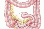 Morbo di Crohn e Rettocolite Ulcerosa: nuove possibilità di intervento
