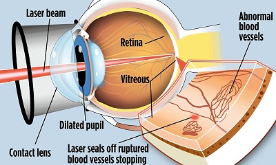 laser-2rt