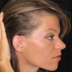 alopecia adrogenetica donna