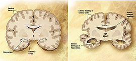 Alzheimer-morbo-ricerca