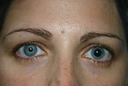 Anisocoria