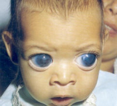 Buftalmo-occhi-vista-pupilla-iride