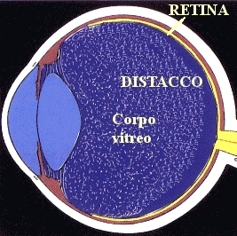 Distacco corpo vitreo-1b