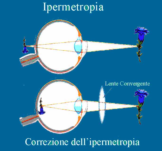 Ipermetropia-correzione-lente-convergente