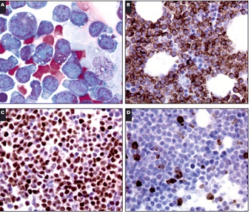 LEUCEMIA-LINFATICA-NEONATALE