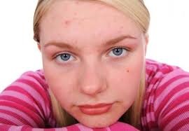 ragazza con viso con presenza di acne