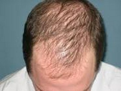 alopecia-androgenica-capelli