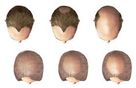 immagine relativa alla caduta dei capelli