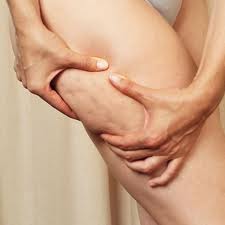 donna mentre mette in evidenza la presenza di cellulite