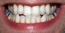 denti-bianchi-sorriso