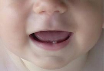 dentini-neonato-gengive