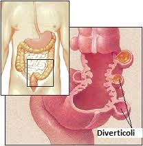 diverticoli-dieta