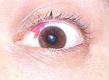 emorragia-occhio-sottocongiuntivale-iposfagma