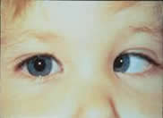 Immagine che riporta un esotropia infantile