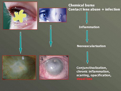 varie immagini in cui si identificano i diversi stadi patologici che interessano l'occhio