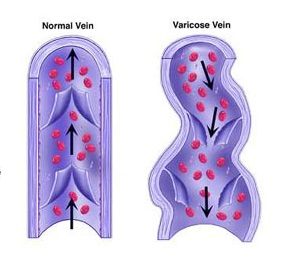 staminali per insufficienza vascolare