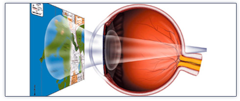 ipermetropia-cause-lenti-biconvesse