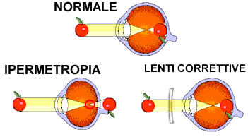 ipermetropia