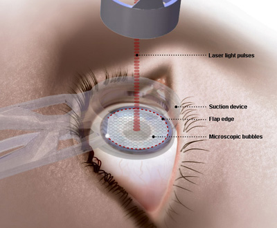 lasek-eye-surgery