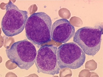 leucemia-mieloide-11q23