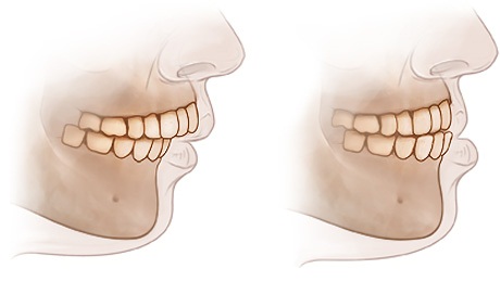 malocclusione