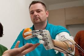 immagine relativa all'impianto di mano sensibile bionica