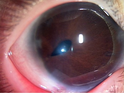 megalocornea-cornea-ochhi-iride