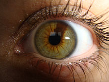 occhi-eterocromia-settoriale-verde-marrone