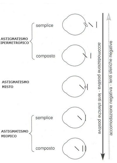 occhio-astigmatismo-ipermetropico-misto copy