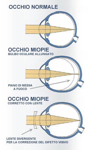 occhio-normale-miopie-bulbo