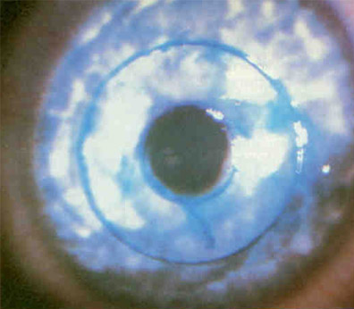occhio-post-operatorio