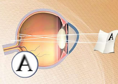 ochhio-astigmatico-oftalmometria