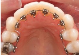 immagine relativa all'ortodonzia linguale