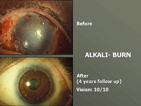 illustrazione di patologia oculare prima e dopo il trattamento