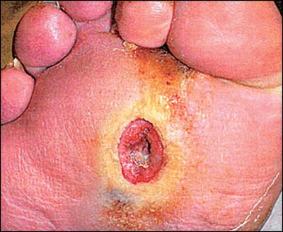 lesione tipica presente nel piede diabetico