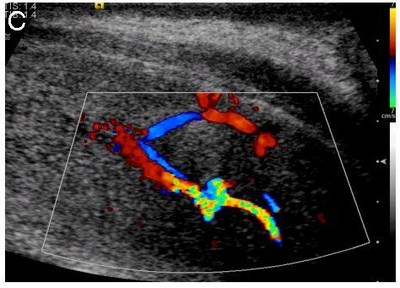 Immagine ecografica in cui si controlla il flusso arterioso