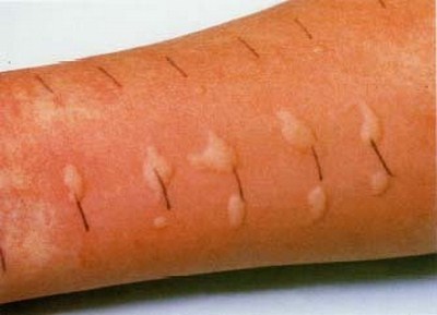 reazione-allergica-allergia-dermatite
