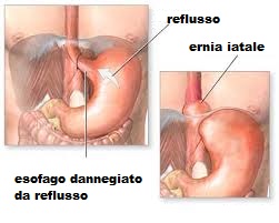 scheda illustrativa reflusso gastro esofageo